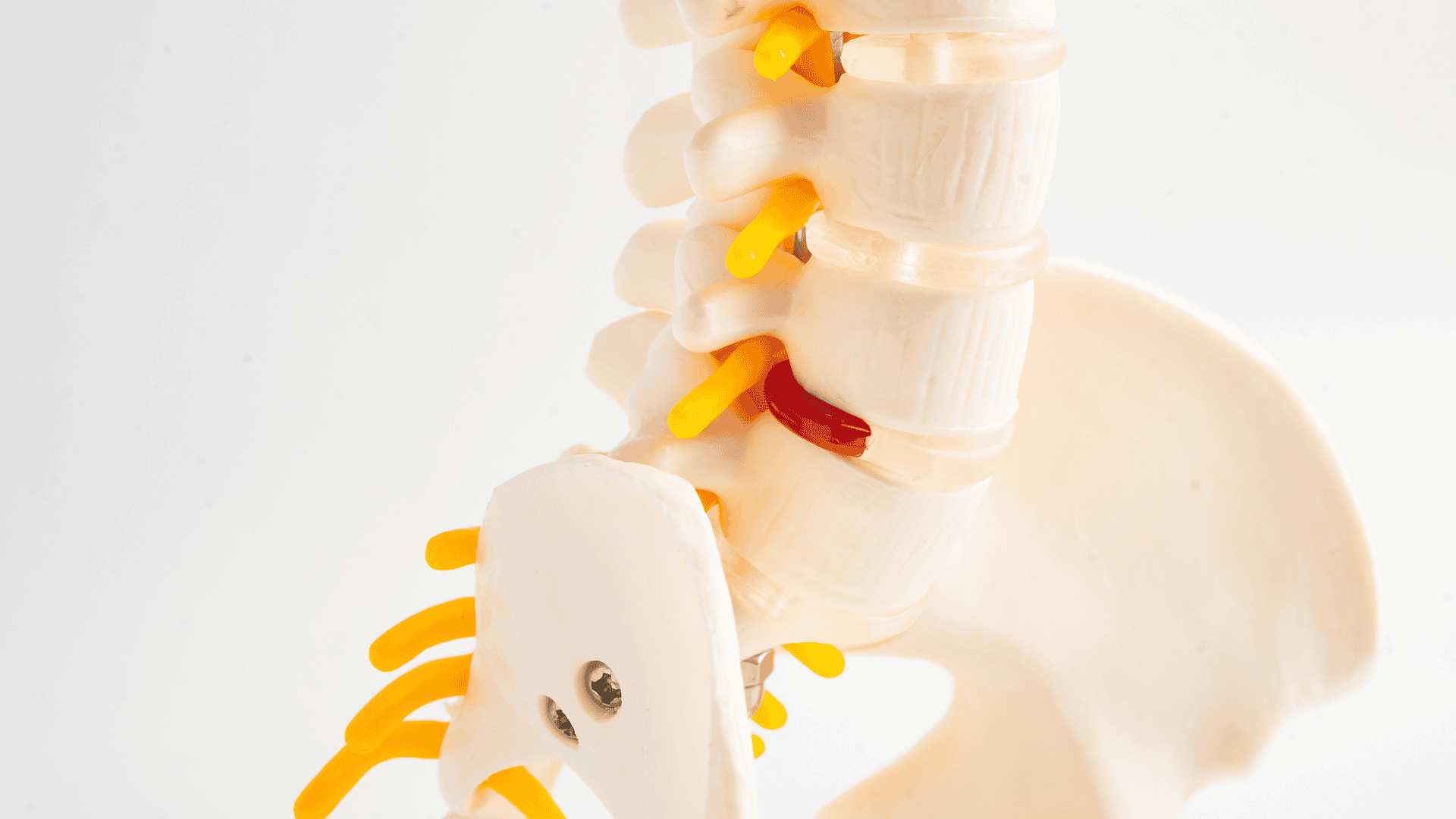 Artifical Cervical Disc Surgery - Wascher Cervical Spine Institute