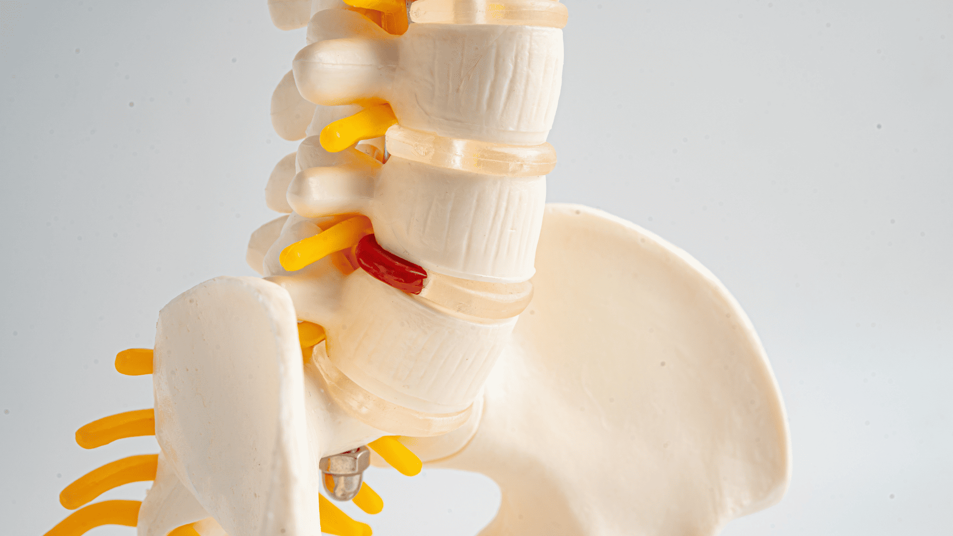 Cervical Disc Herniation Treatment by Wascher Cervical Spine Institute