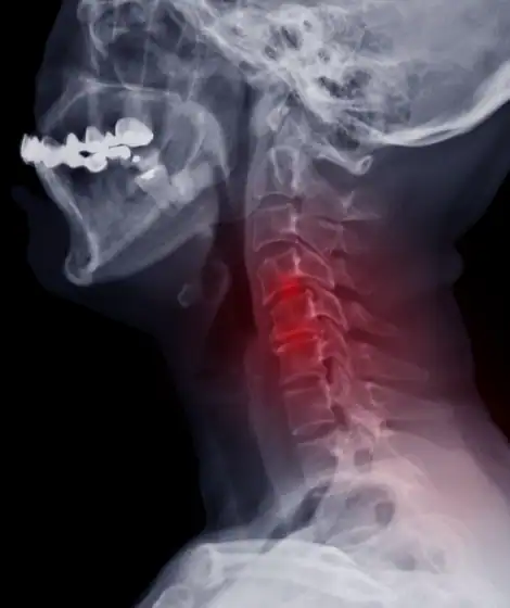 Cervical Myelopathy - Wascher Cervical Spine Institute