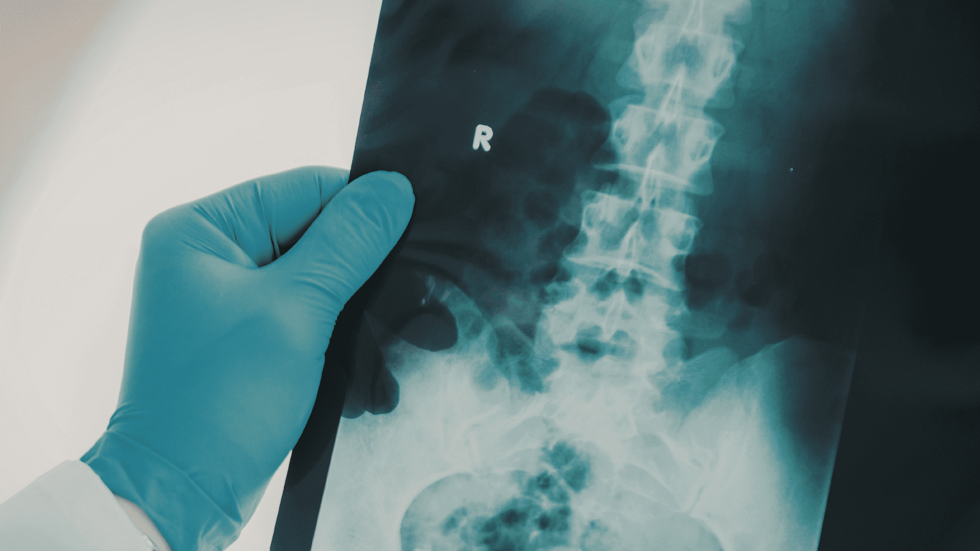 Cervical Spine Fusion - Wascher Cervical Spine Institute