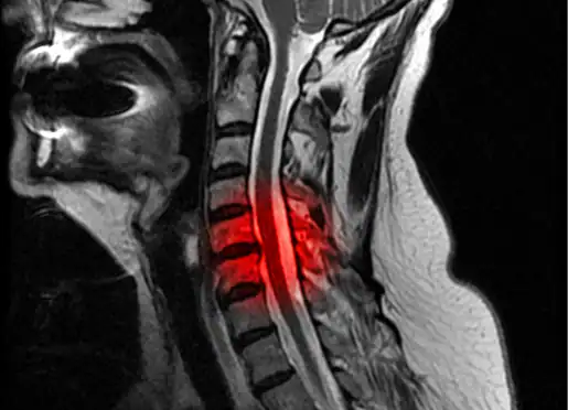 Ossification of the posterior longitudinal Ligament - Wascher Cervical Spine Institute