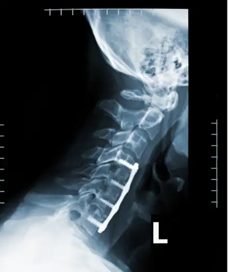 Primary Tumors of the Cervical Spine - Wascher Cervical Spine Institute