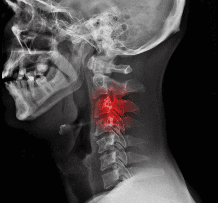 Cervical Discectomy | Wascher Cervical Spine Institute