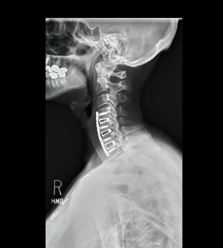 Multilevel Anterior Fusion for Kyphosis - Case Study (Wascher Cervical Spine Institute)
