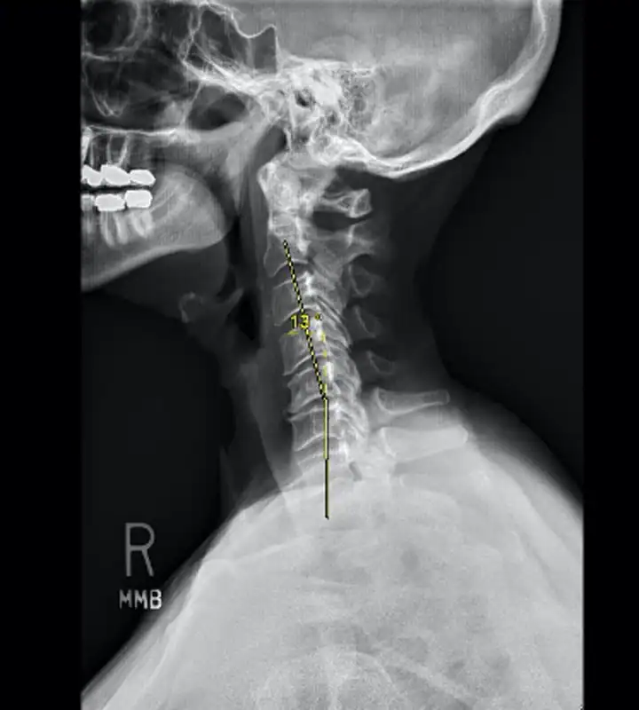 Multilevel Anterior Fusion for Kyphosis - Case Study (Wascher Cervical Spine Institute)
