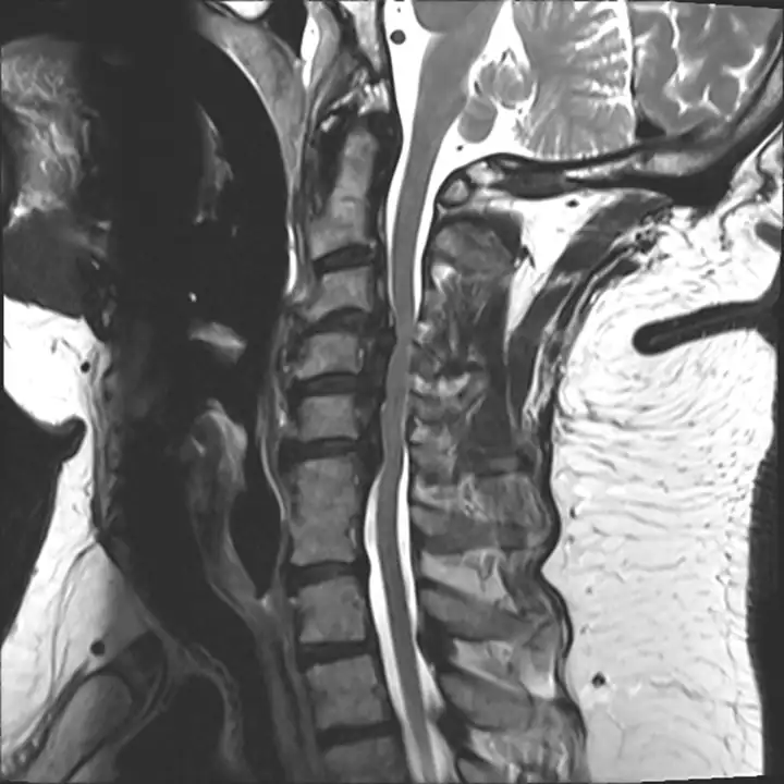 OPLL Cervical Spine Case Study - Wascher Cervical Spine Institute