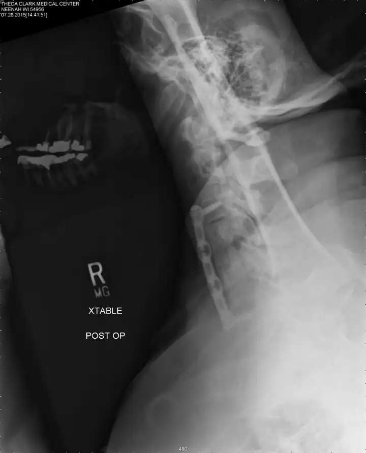 opll case study wascher cervical spine institute 2