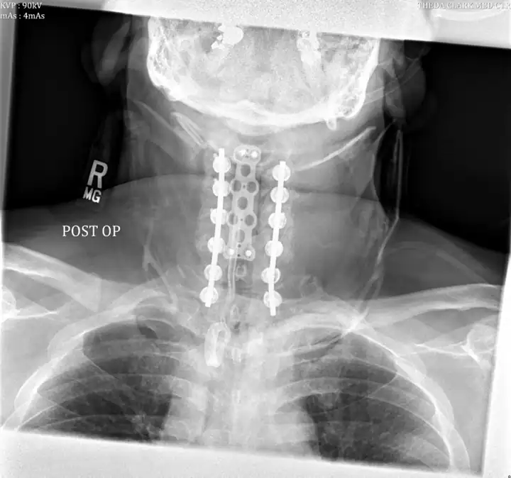 opll case study wascher cervical spine institute 3