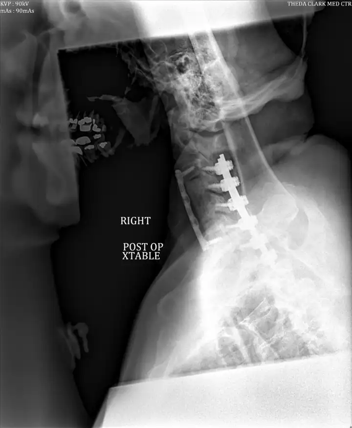 opll case study wascher cervical spine institute 4